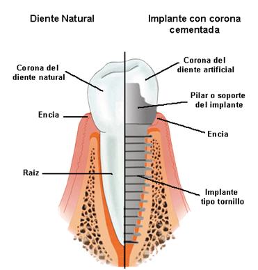 Implantología dental