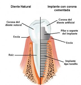 Los implantes dentales